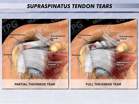 supraspinatus tendon tear test|complete tear supraspinatus tendon.